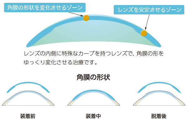 イラスト：角膜の形状を変化させるゾーン・レンズを安定させるゾーン